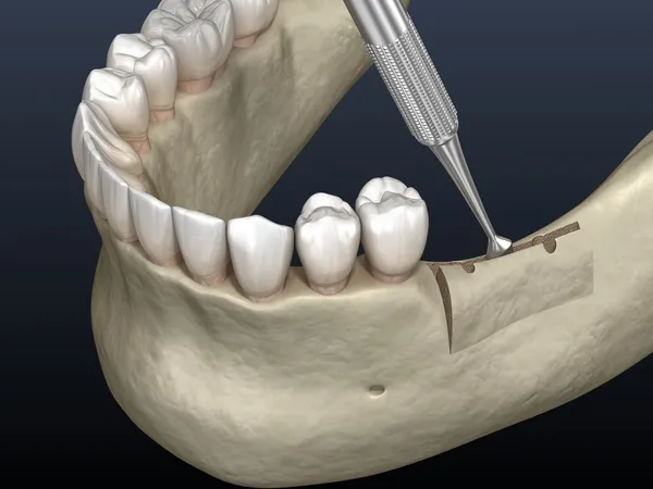 Dental implant preparation