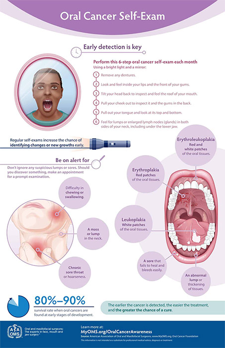 oral cancer self exam grahpic
